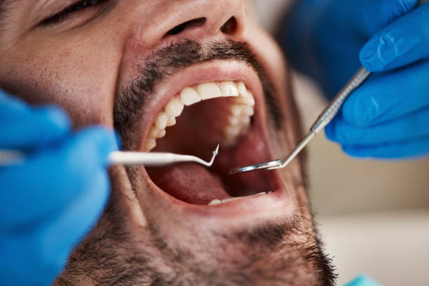Best Emergency Treatment for Dental Infections or Abscesses in Orangetree, FL